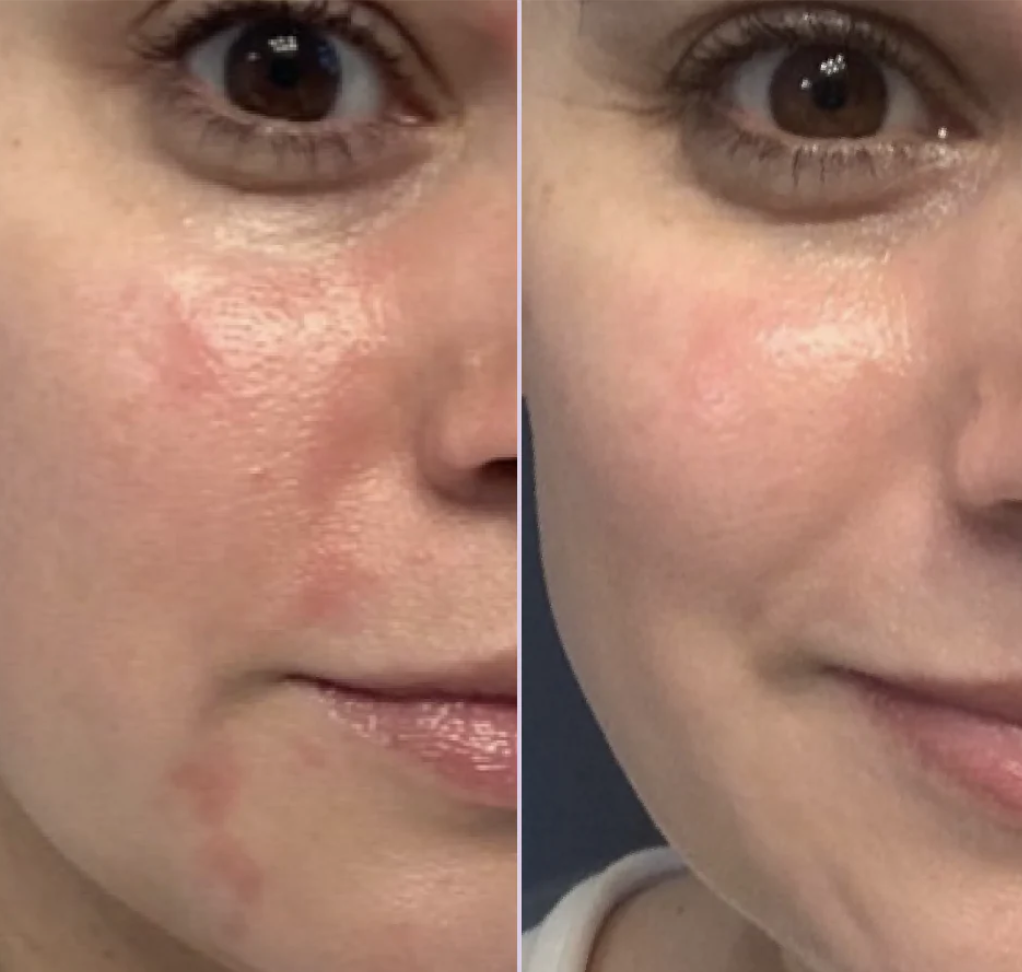 a before and after, a woman who had severe blemishes on her face and after when it is cleared up, purportedly from the Tower 28 spray.